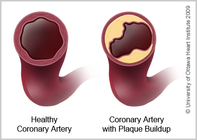 Coronary Artery Disease